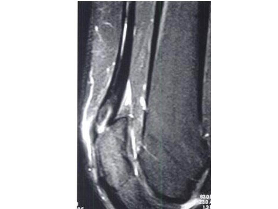 Quadriceps Tendonitis Knee & Sports Orthobullets